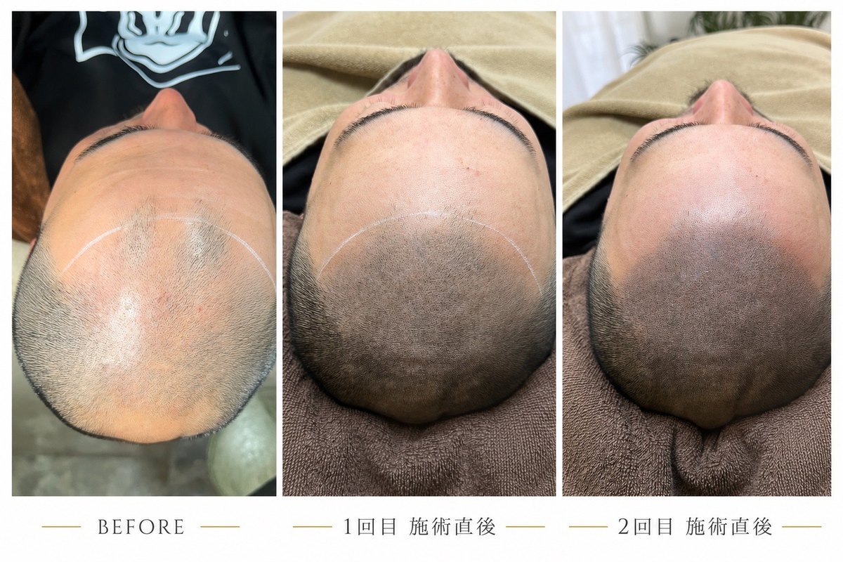 頭皮タトゥー 症例 8