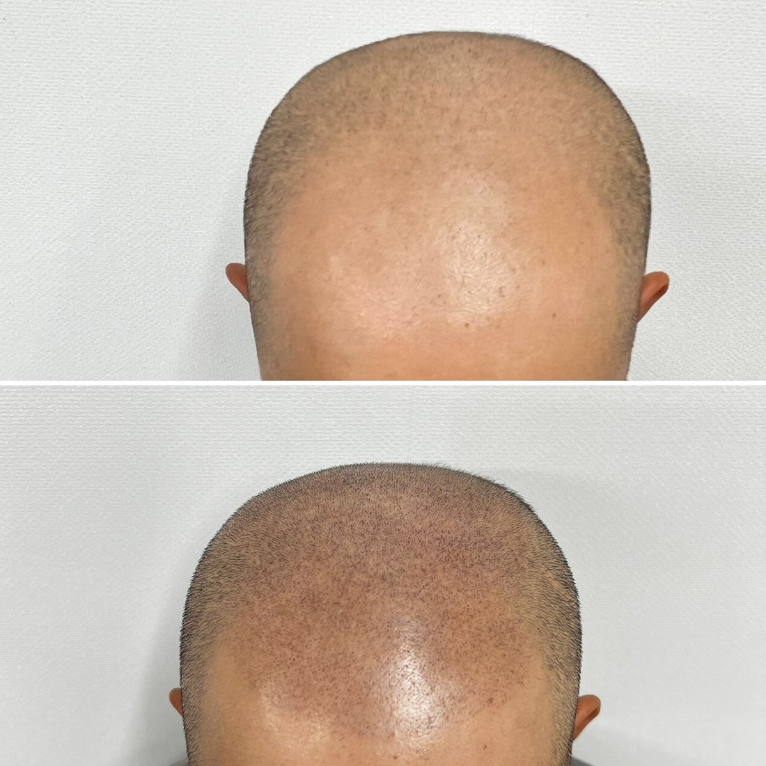 頭皮タトゥー before after