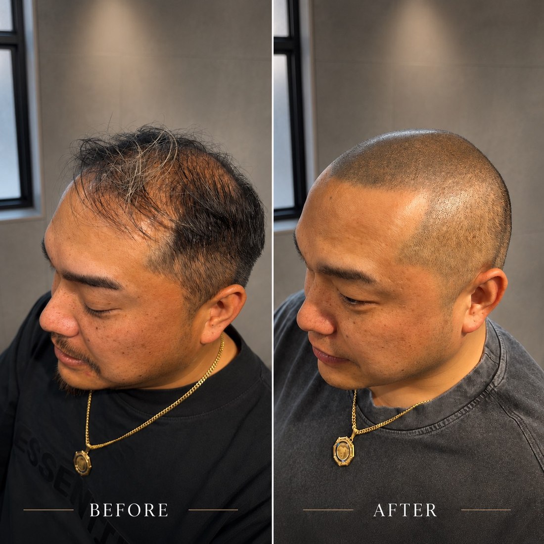 頭皮タトゥー before / after