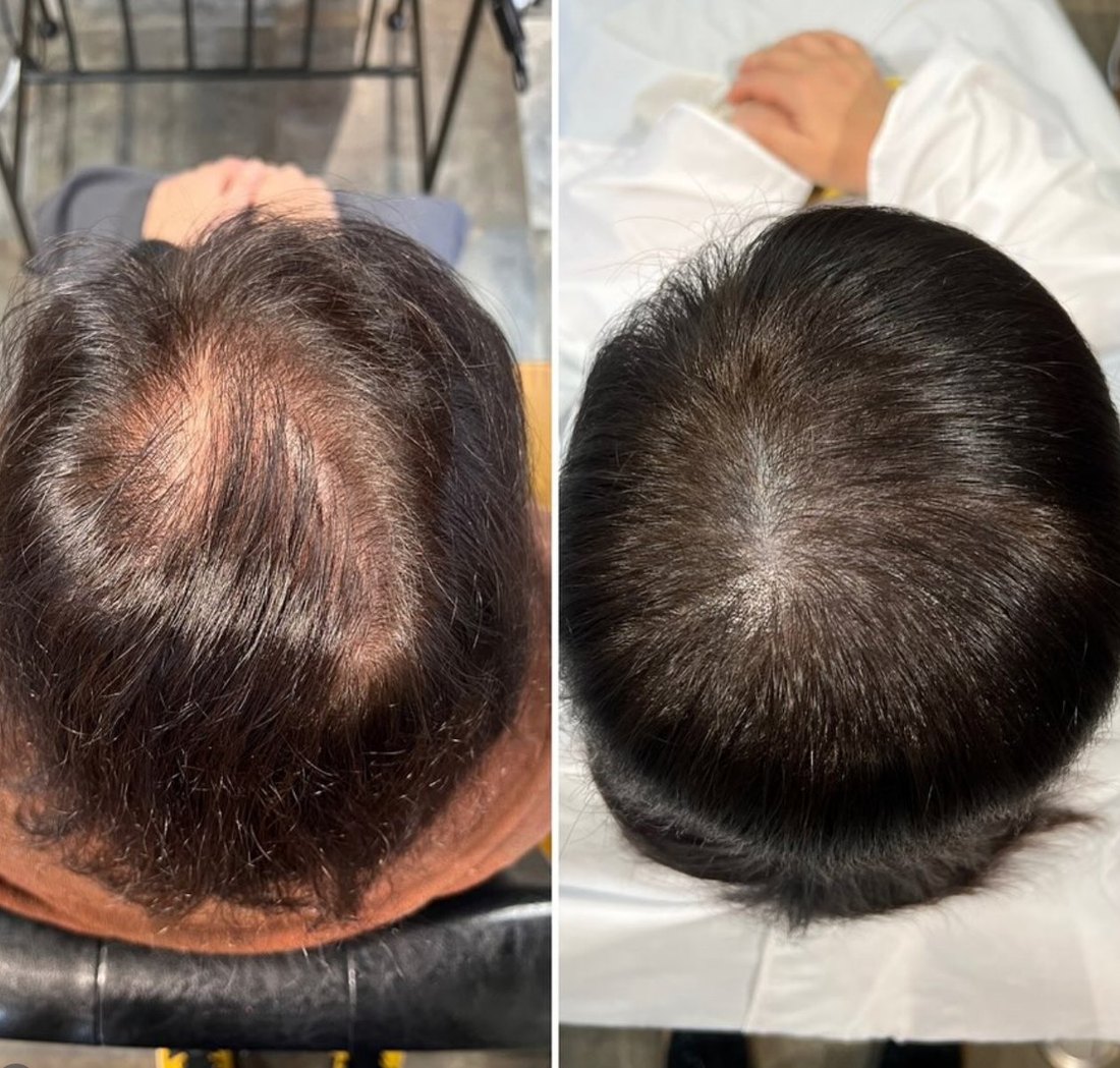 頭皮タトゥー before after